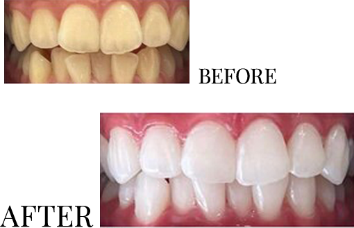 どこよりも白くなる圧倒的な効果